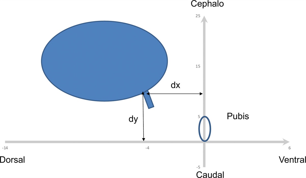Effect of pelvic floor muscles exercises by extracorporeal magnetic innervations on the bladder neck and urinary symptoms