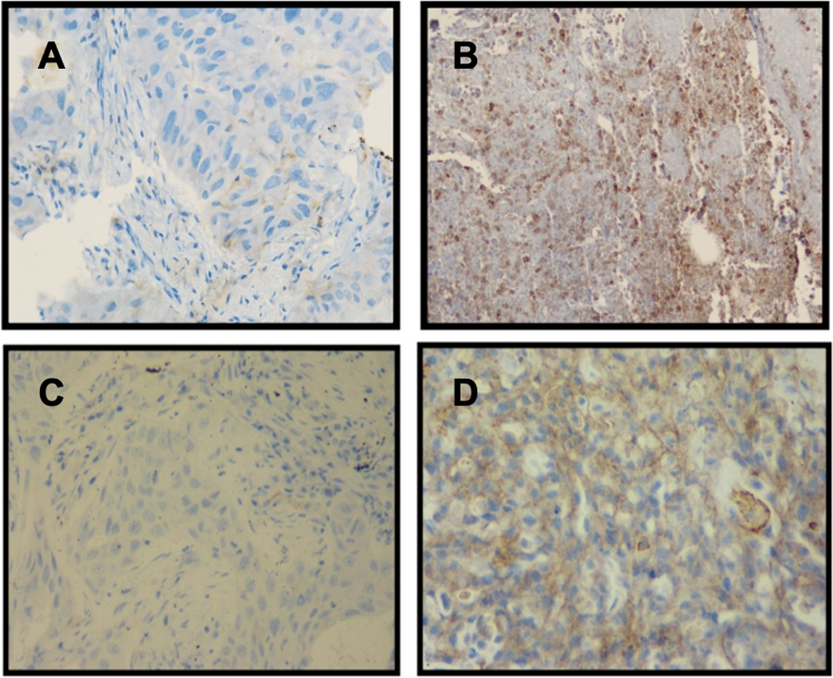 PD-L1 expression and its significance in advanced NSCLC: real-world experience from a tertiary care center