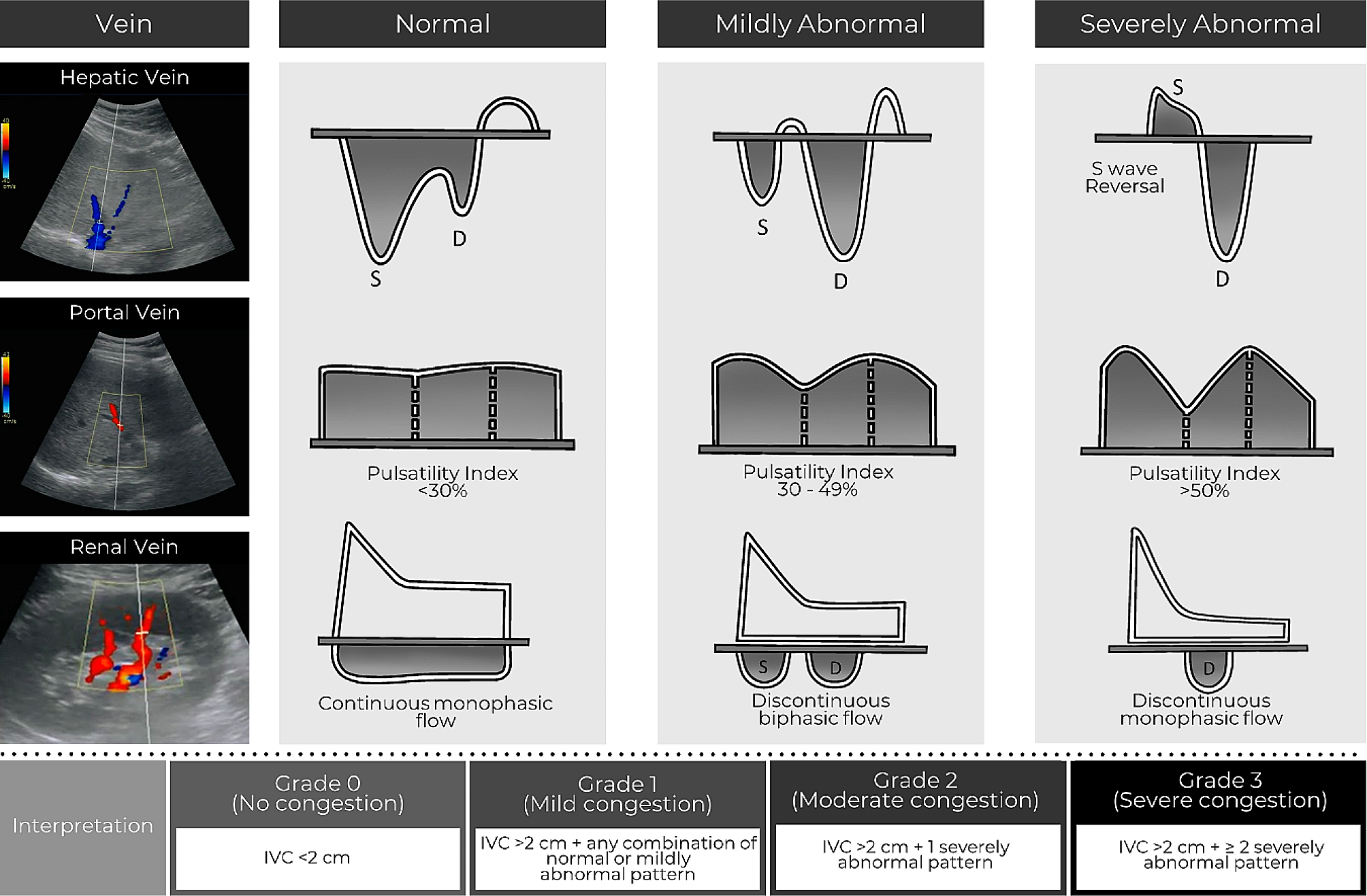 Utility of the Venous Excess Ultrasound (VEXUS) score to track dynamic change in volume status in patients undergoing fluid removal during haemodialysis – the ACUVEX study