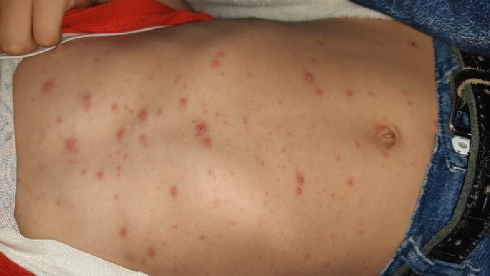 Pediatric Peripheral Facial Palsy Following Varicella Zoster Infection
