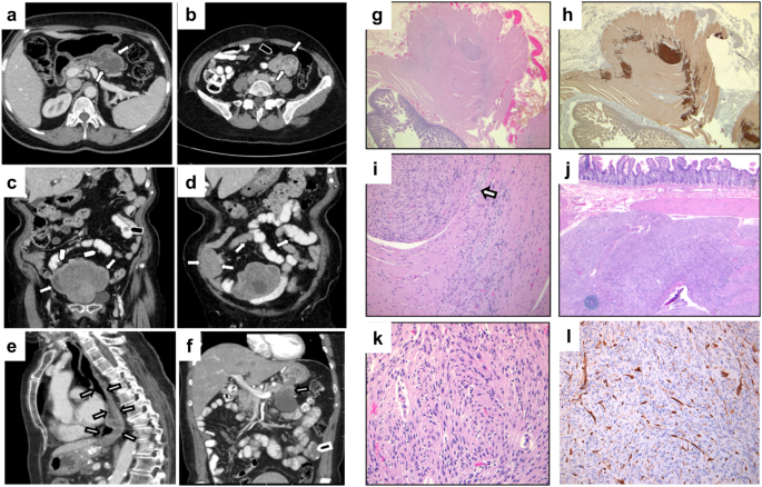 Genomic and clinical characterization of a familial GIST kindred intolerant to imatinib