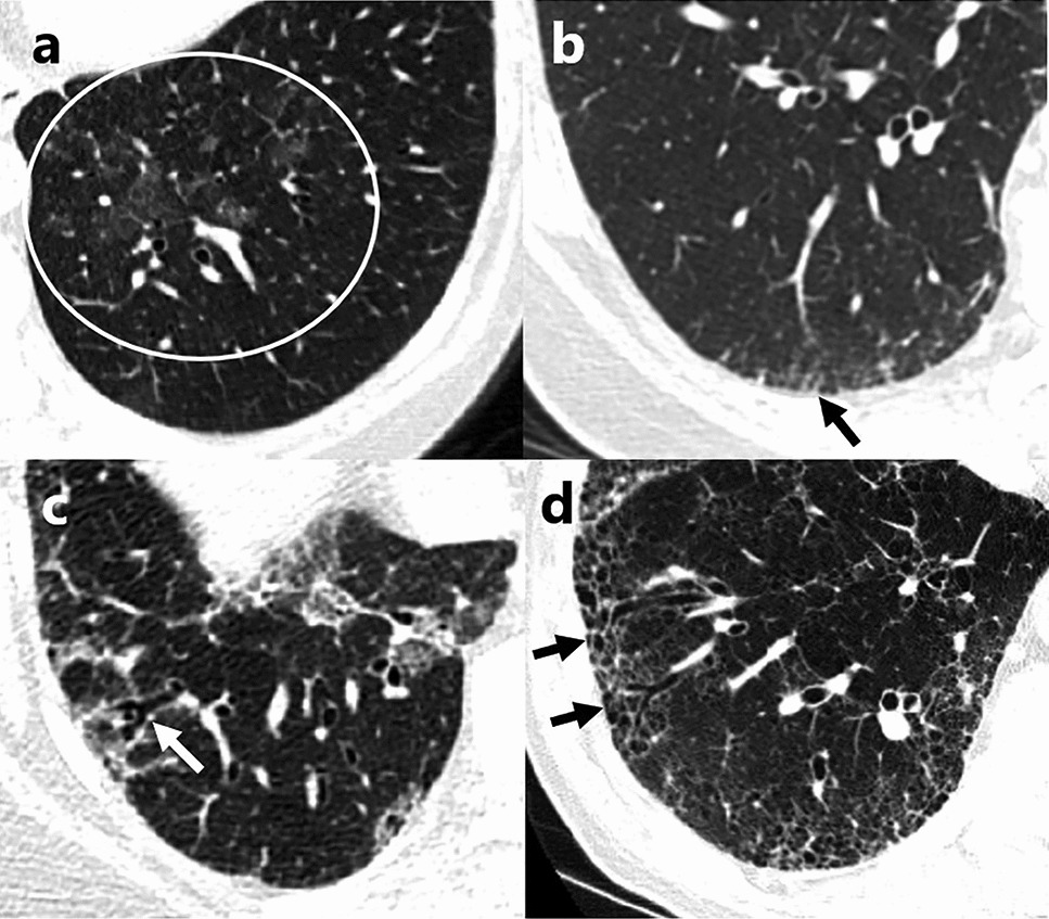 Interstitial Lung Abnormalities (ILA) and Pulmonary Fibrosis