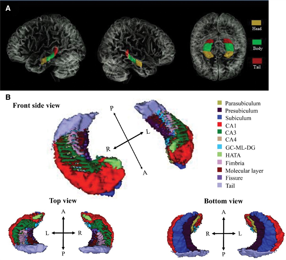 Hippocampal subfields in remitted schizophrenia