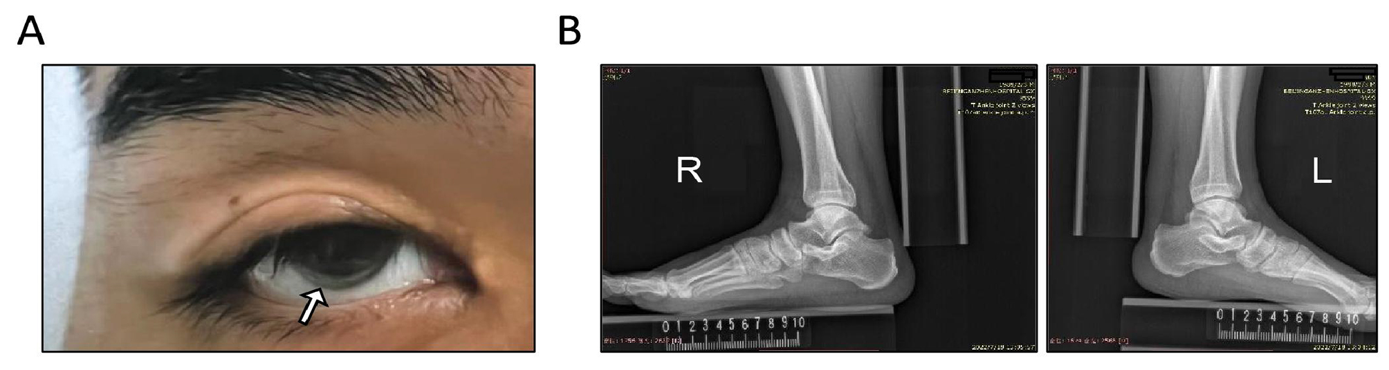 LDLR c.89_92dup: a novel frameshift variation in familial hypercholesterolemia