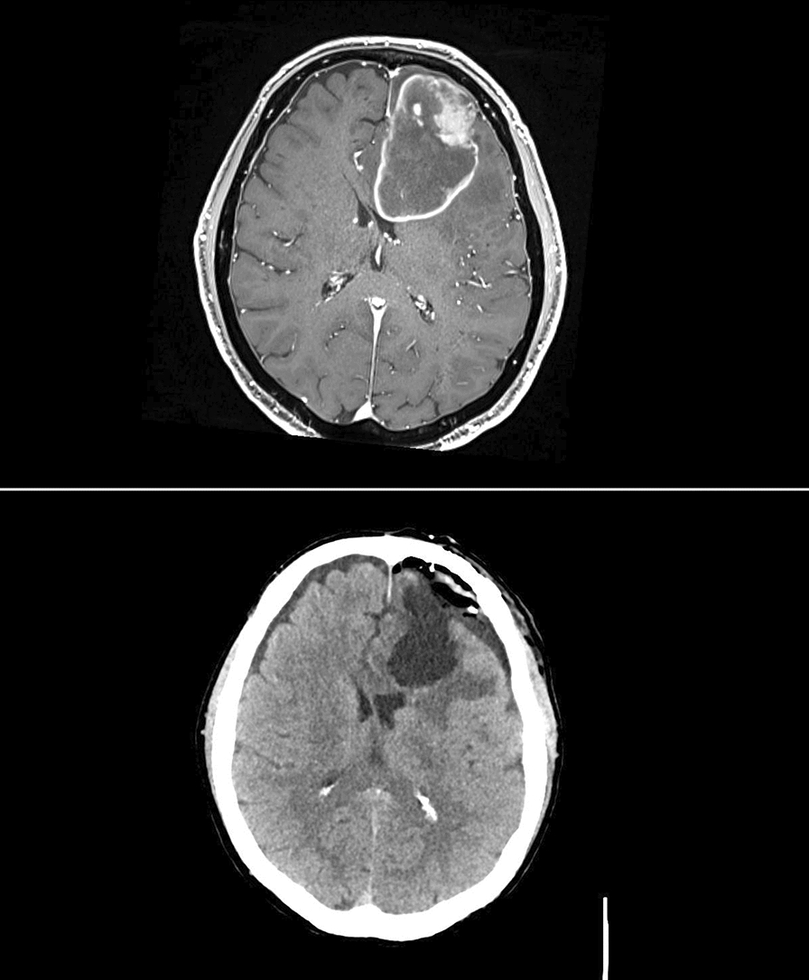 Emergent Coronary Thrombectomy for Acute Myocardial Infarction Immediately Following Craniotomy with Tumor Resection
