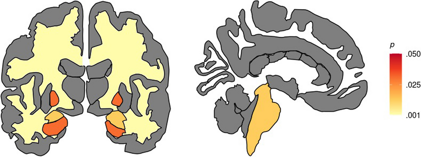 Volumetric brain reductions in adult patients with phenylketonuria and their relationship with blood phenylalanine levels