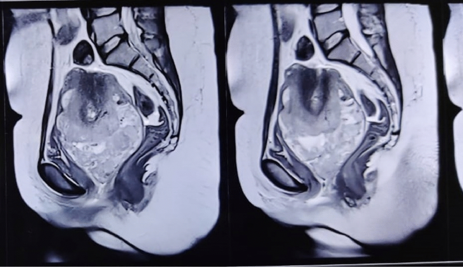 A Rare Case of Non-Puerperal Uterine Inversion Associated with Adenosarcoma of the Uterus: A Case Report