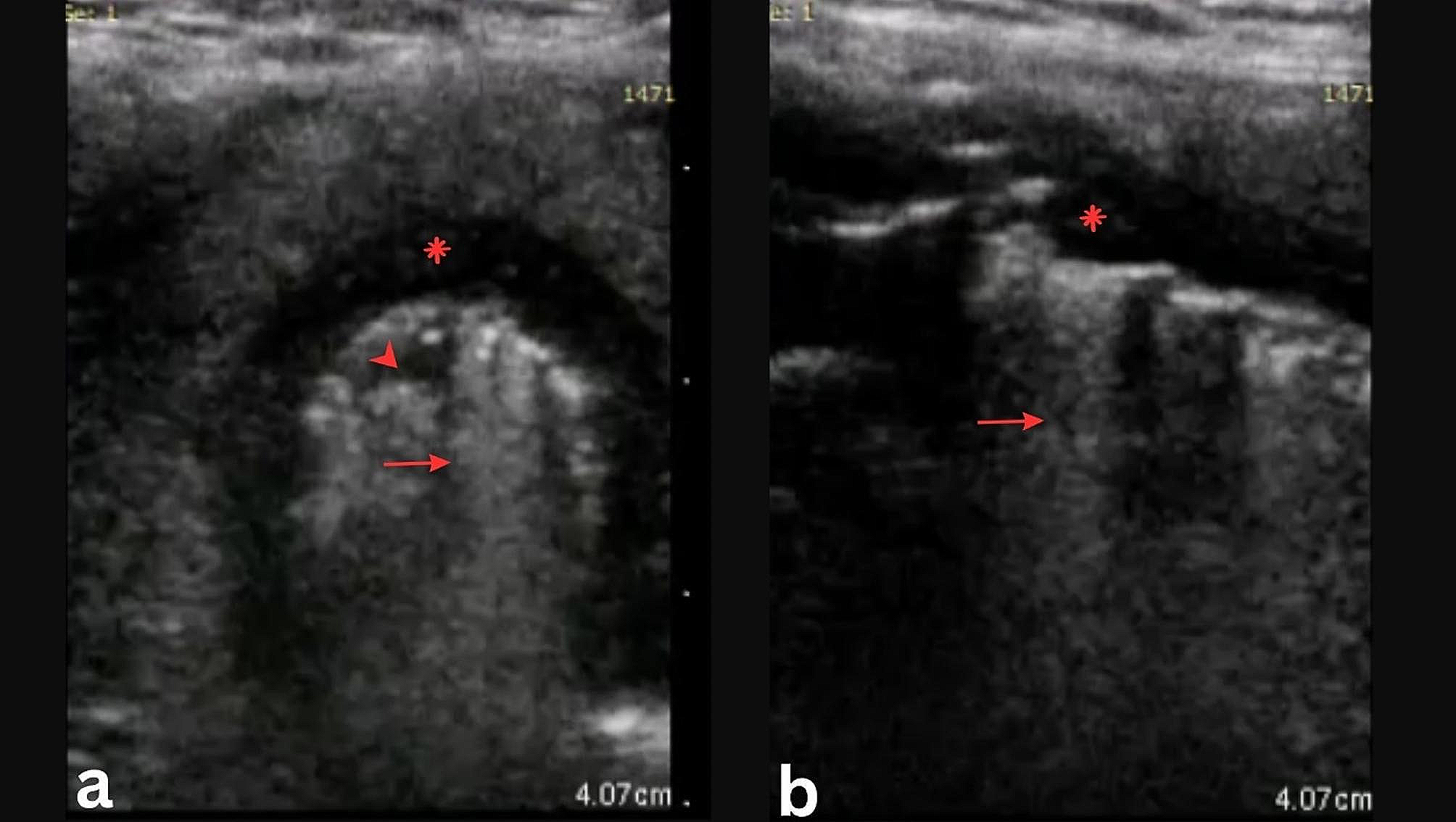 The role of upper airway ultrasonography in tracheal necrosis diagnosis: a case report