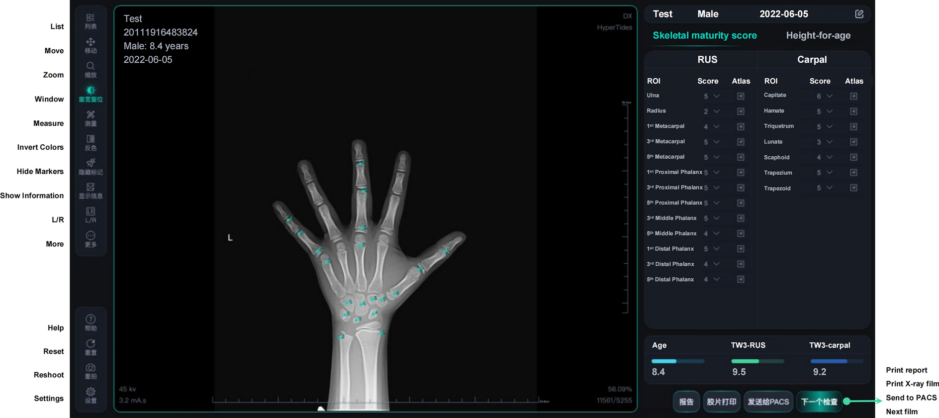 Validation of an AI-Powered Automated X-ray Bone Age Analyzer in Chinese Children and Adolescents: A Comparison with the Tanner–Whitehouse 3 Method