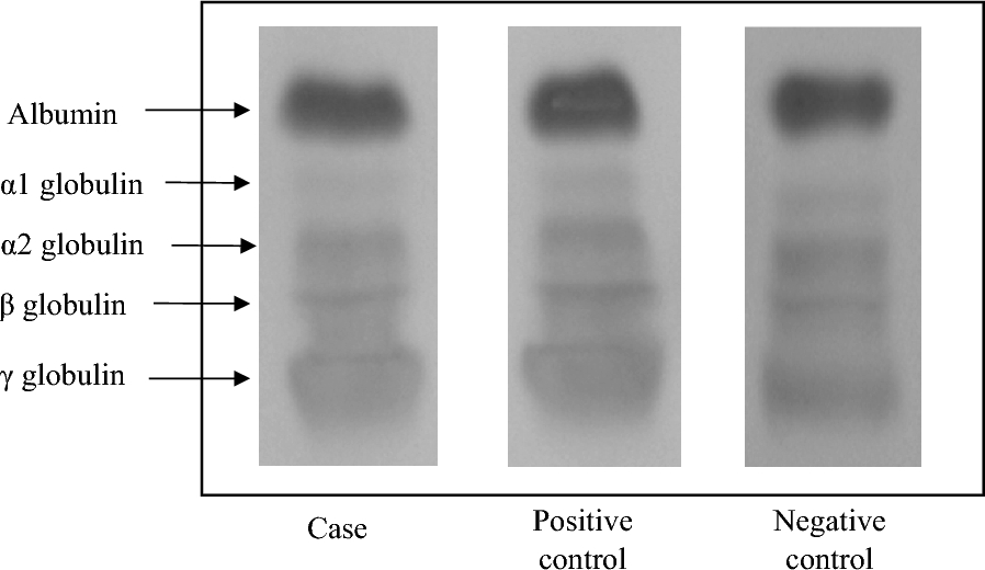 Cellulose acetate electrophoretic separation of serum and urine proteins in Nigerian children with autism spectrum disorders