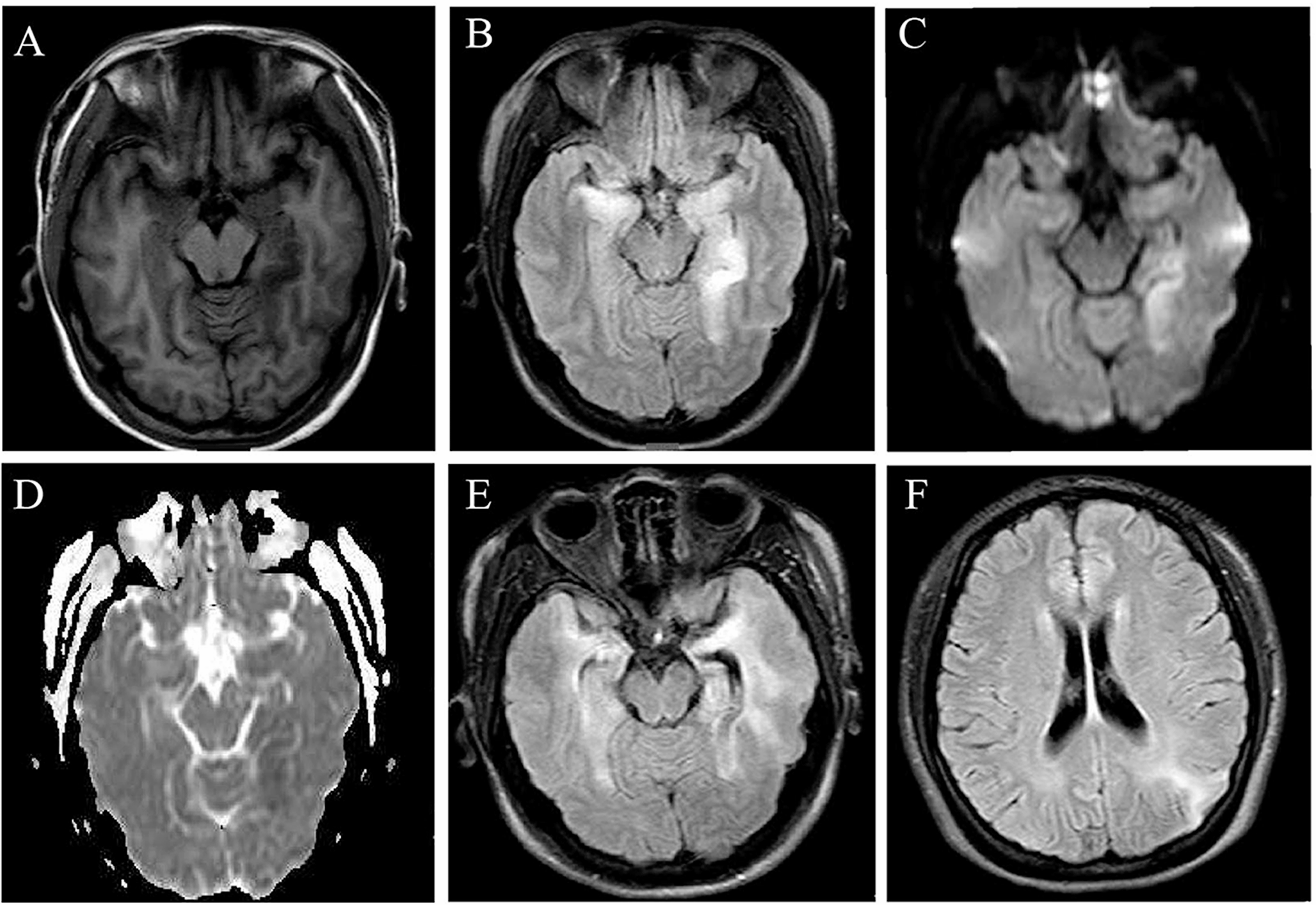 Type 2 herpes simplex virus-induced anti-N-methyl-d-aspartate receptor encephalitis responsive to immunoglobulin monotherapy