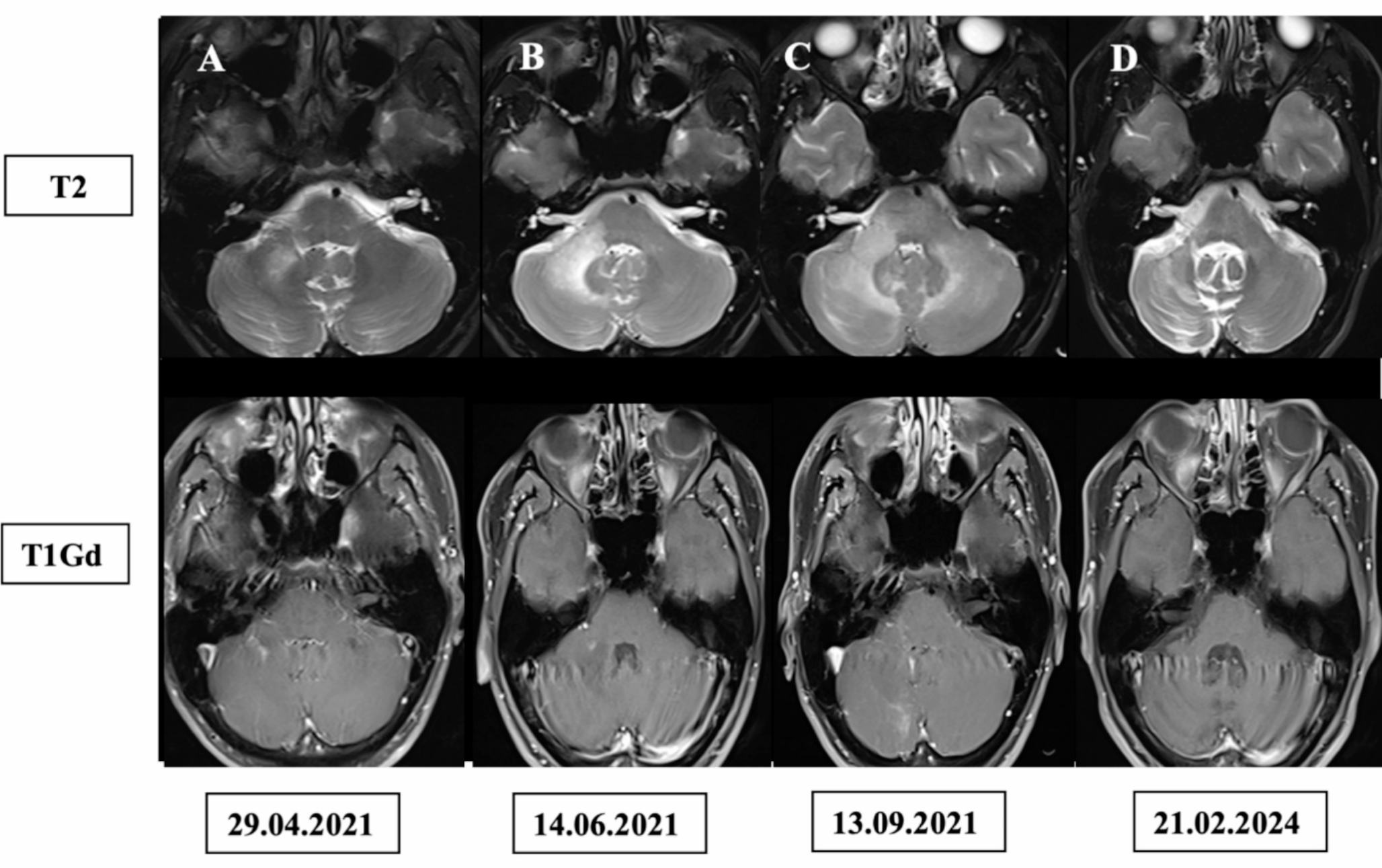 Progressive multifocal leukoencephalopathy in sarcoidosis successfully treated with pembrolizumab