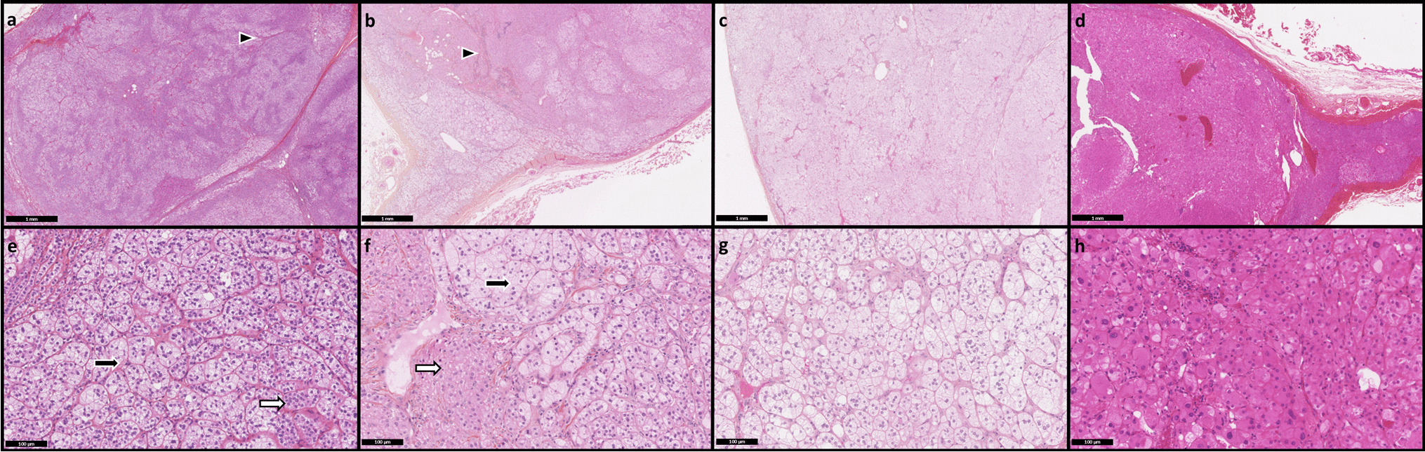Somatic Molecular Heterogeneity in Bilateral Macronodular Adrenocortical Disease (BMAD) Differs Among the Pathological Subgroups