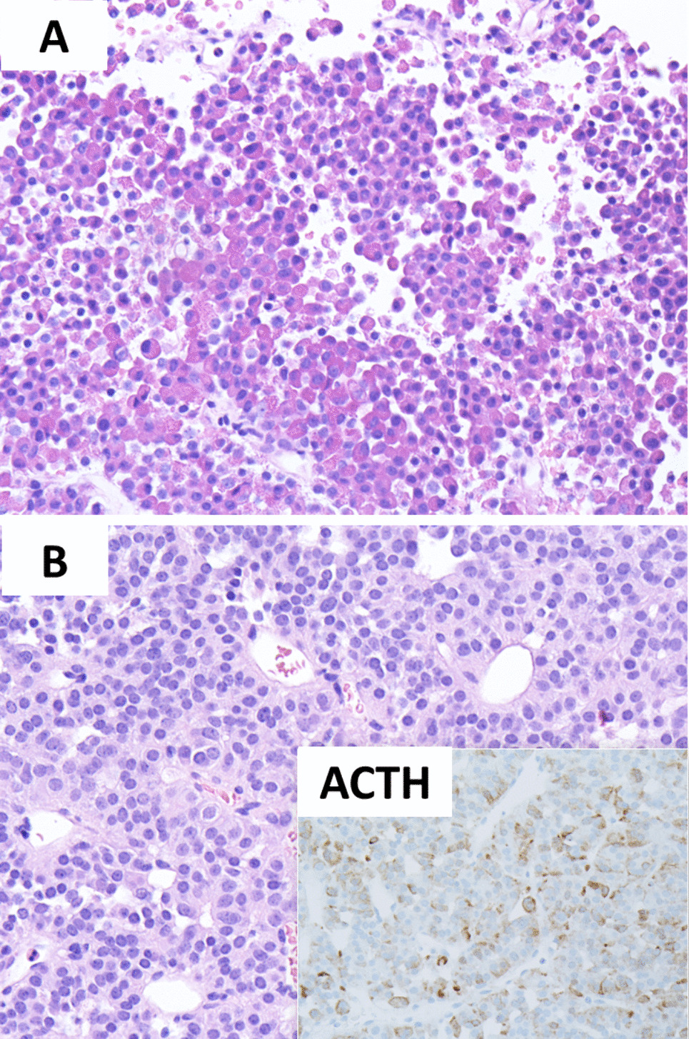 Granulation Patterns of Functional Corticotroph Tumors Correlate with Tumor Size, Proliferative Activity, T2 Intensity-to-White Matter Ratio, and Postsurgical Early Biochemical Remission