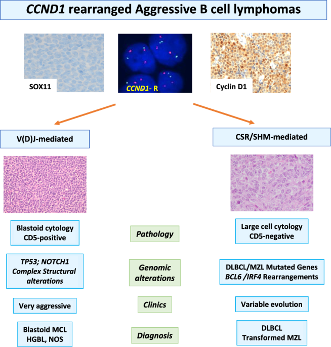 Large B-cell lymphomas with CCND1 rearrangement have different immunoglobulin gene breakpoints and genomic profile than mantle cell lymphoma