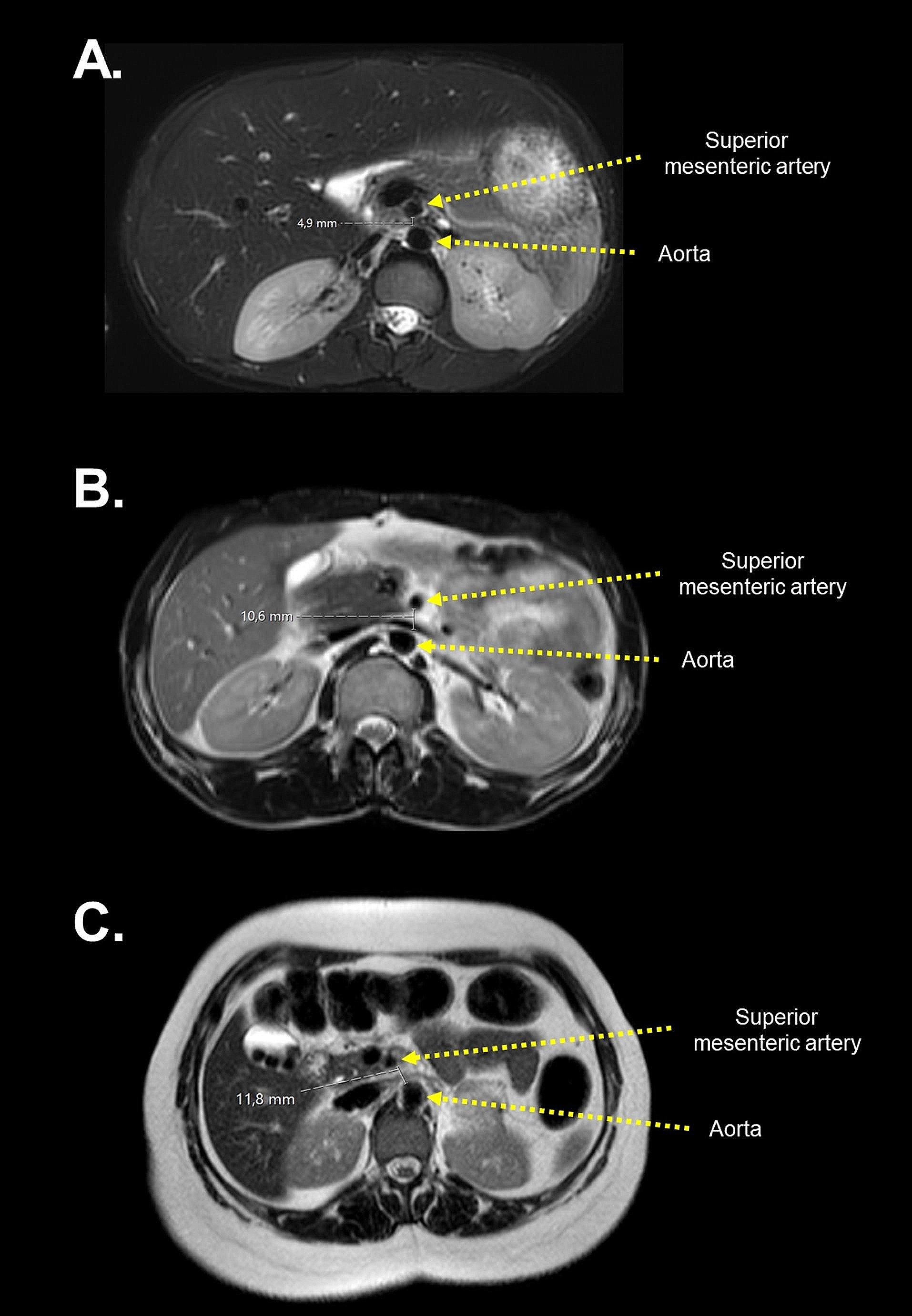 Assessment of aortomesenteric distance and mesenteric and retroperitoneal adipose tissue thickness in genetic forms of lipodystrophy