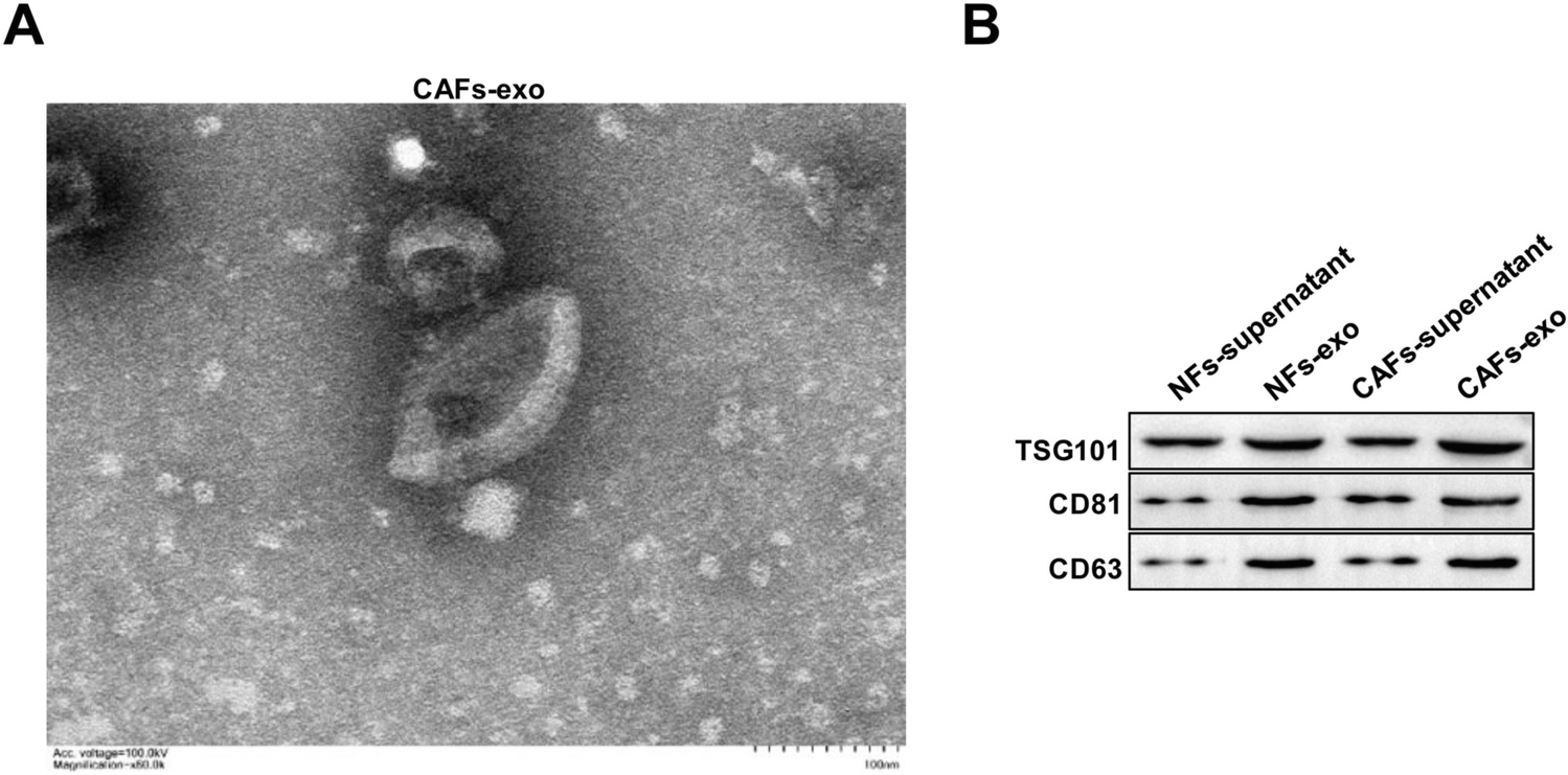 Cancer-associated fibroblast-secreted exosomal miR-454-3p inhibits lipid metabolism and ferroptosis in breast cancer by targeting ACSL4