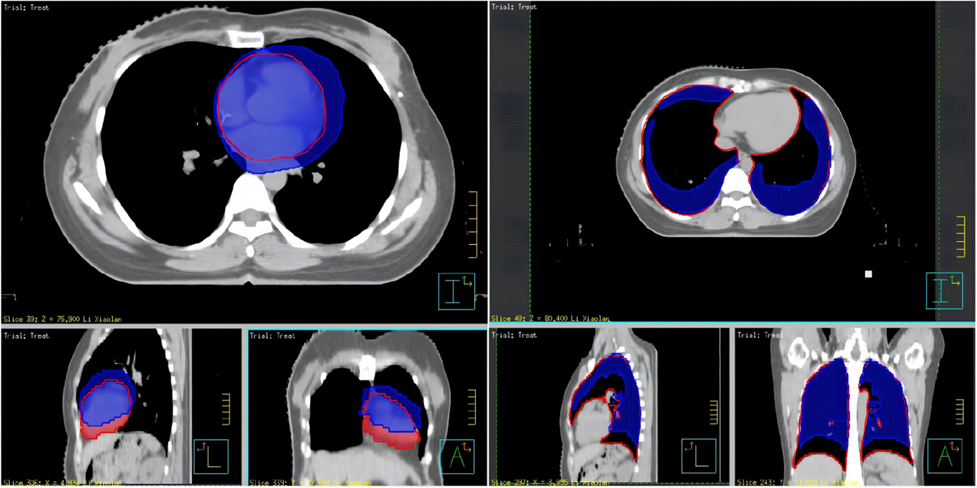 Dose advantage of abdominal deep inspiratory breath-hold (aDIBH) in postoperative adjuvant radiotherapy for left breast cancer