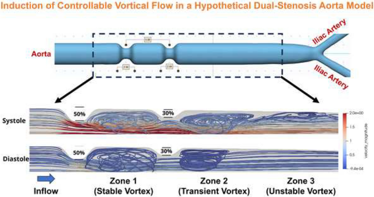 Induction of Controllable Vortical Flow in a Dual-Stenosis Aorta Model: A Replication of Disordered Eddies Flow in Aneurysms
