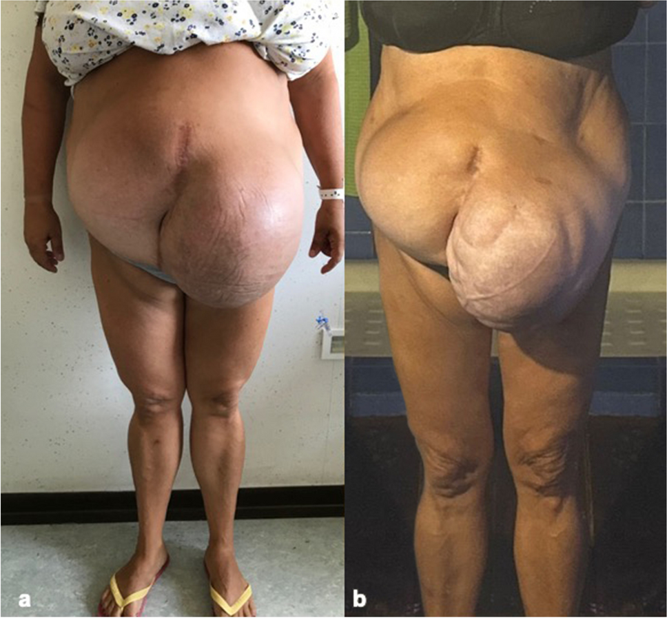 Impenetrable Abdomen: A Case Report of Endoscopic Sleeve Gastroplasty Performed in Patient with Huge Paramedian Laparocele