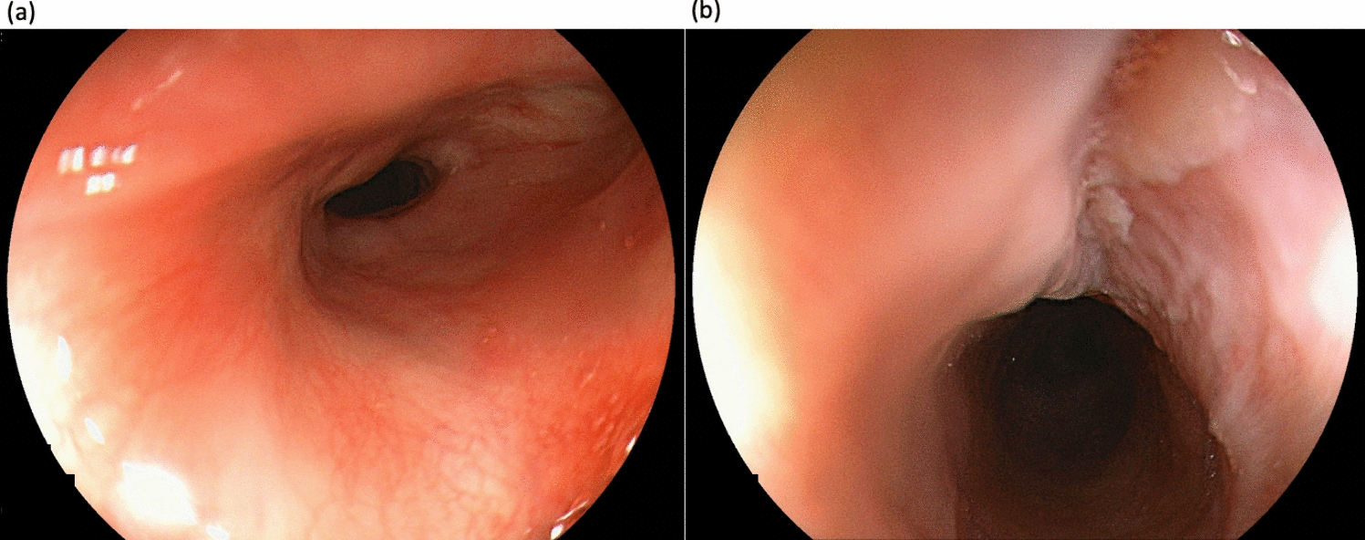 A case of esophageal squamous cell carcinoma with epidermization showing a unique morphology