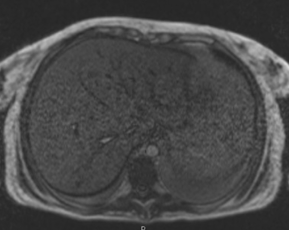 Arsenic and young liver: a case report of hepatic steatosis due to arsenic toxicity