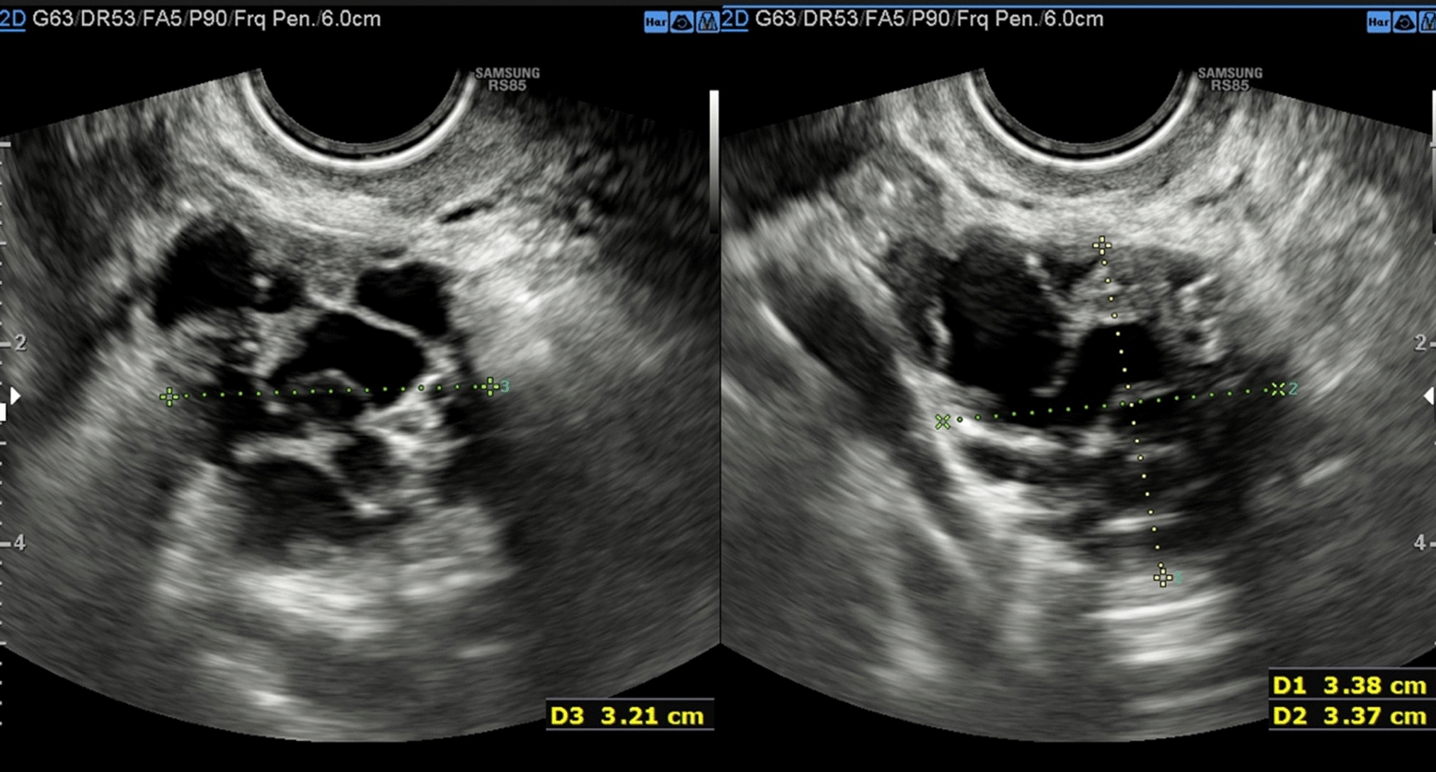 Female Adnexal Tumor of Probable Wolffian Origin (FATWO): Case Report and Systematic Literature Review