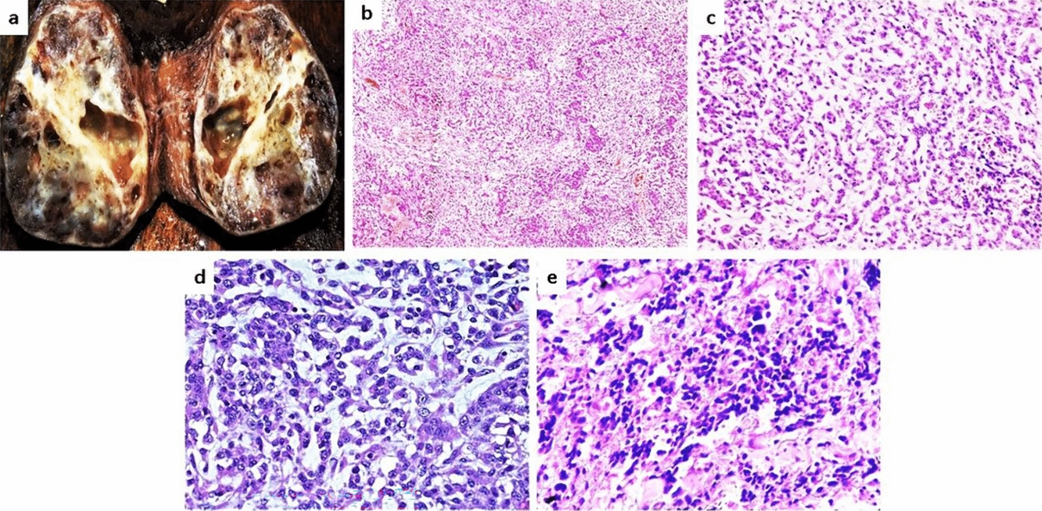 Small Cell Carcinoma, Hypercalcemia Type of Ovary: Confronting a Rare and Lethal Histological Variant