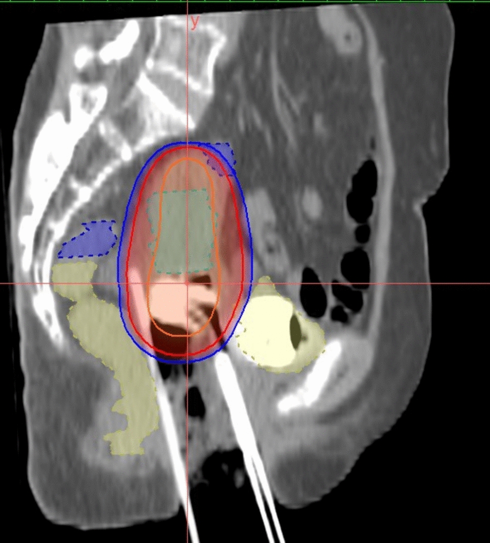 Utrecht Applicator for Combined Intracavitary/Interstitial Brachytherapy in Locally Advanced Cancer Cervix: Feasibility and Plan Comparison