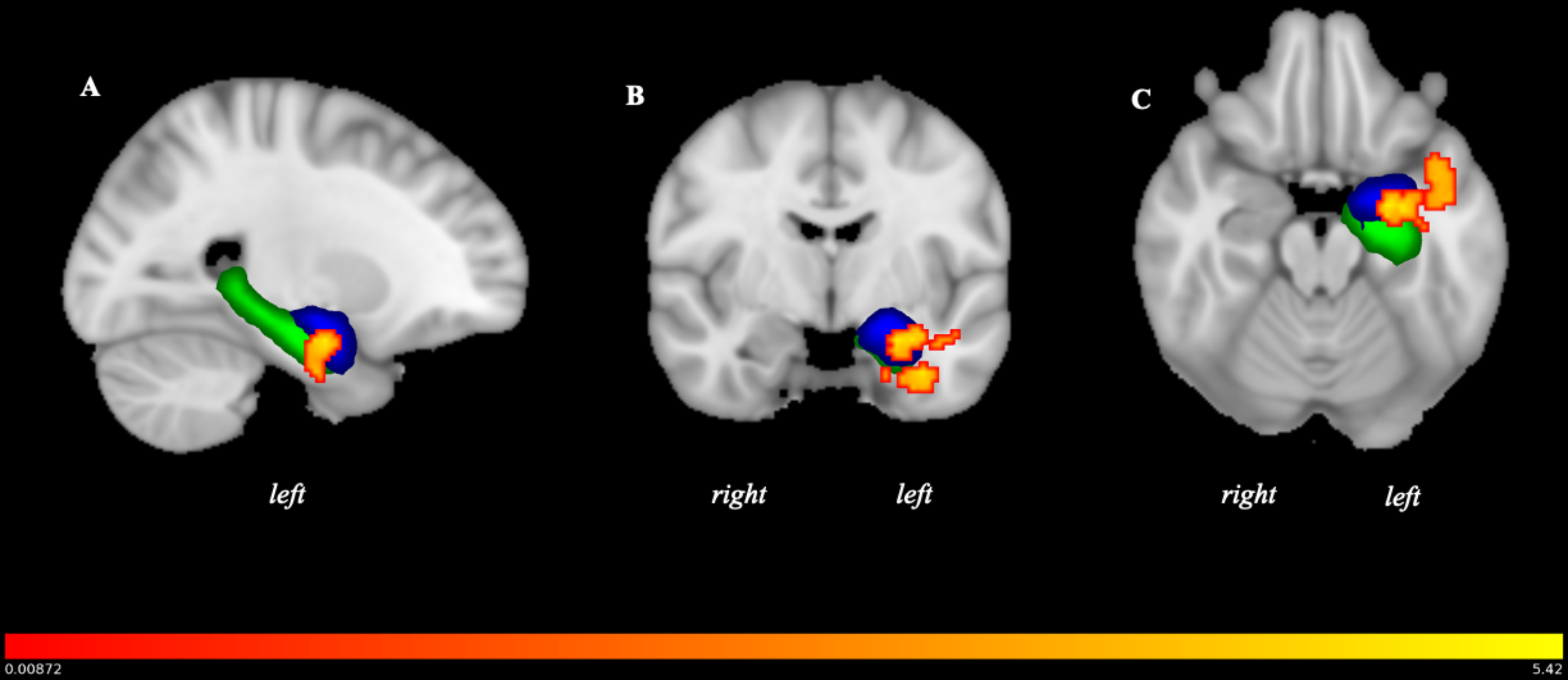 Family Members’ Reward-Based Activation in Response to an AUD Loved-One