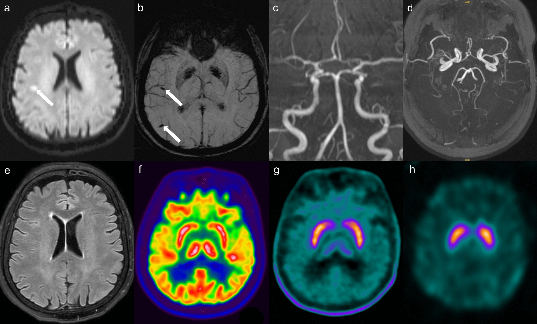 Complete resolution of restless legs syndrome following ischemic stroke of the right middle cerebral artery
