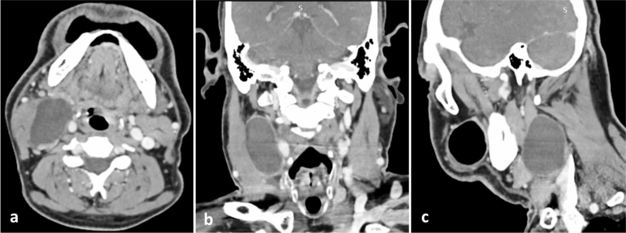 Lymphoepithelial Cyst in the Elderly Neck: A Diagnostic Conundrum