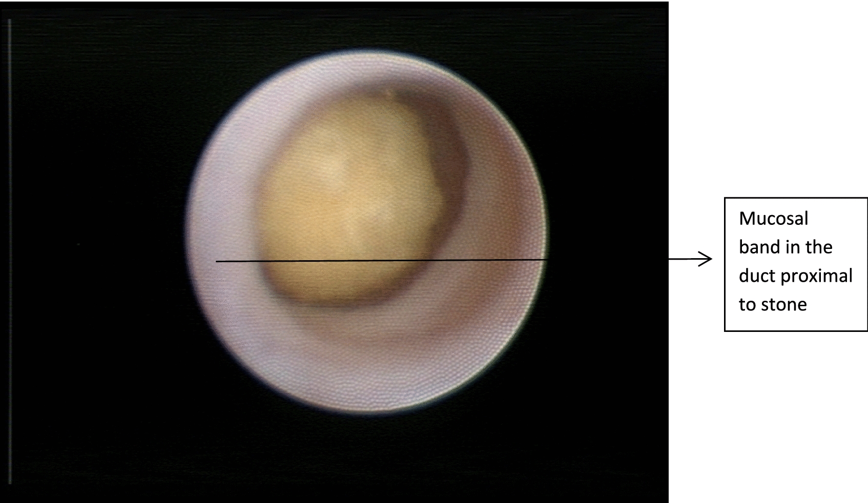 To Evaluate the Success of Sialendoscopy Assisted Intraoral Approach for Removal of Submandibular Hilar Stones
