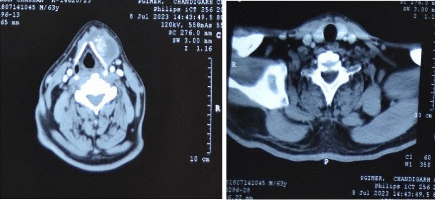 Papillary Carcinoma of Thyroglossal Duct Cyst—A Case Series