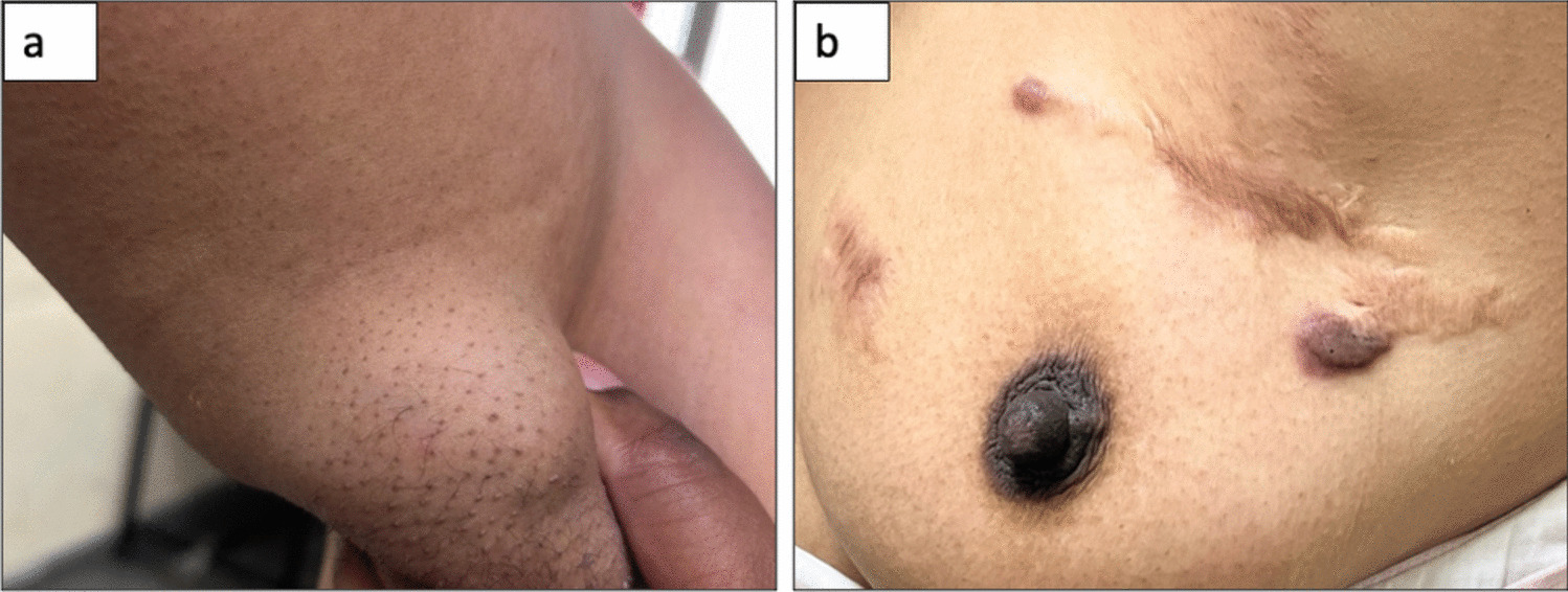 A Rare Case of Axillary Fibroadenoma in Accessory Breast Masquerading Malignancy