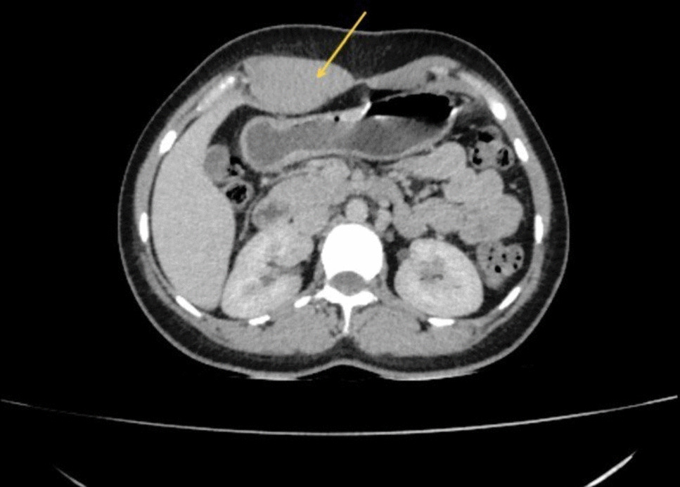 Aggressive Fibromatosis in the Abdominal Wall: A Rare Case of Intramuscular Desmoid Tumor