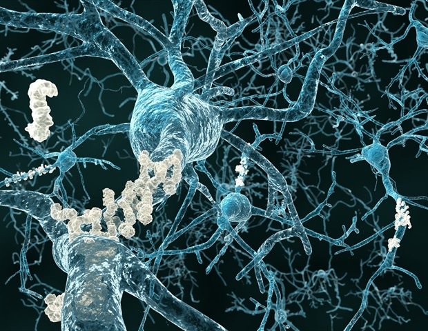 Researchers use cerebrospinal fluid to unlock pathways in Alzheimer's disease