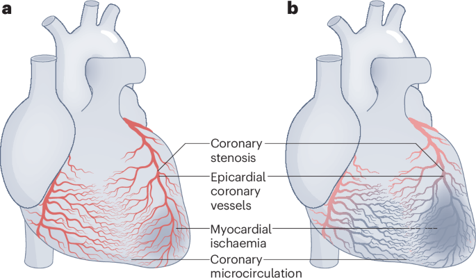 Trade-offs between vessel-based and substrate-based nomenclatures for coronary heart diseases
