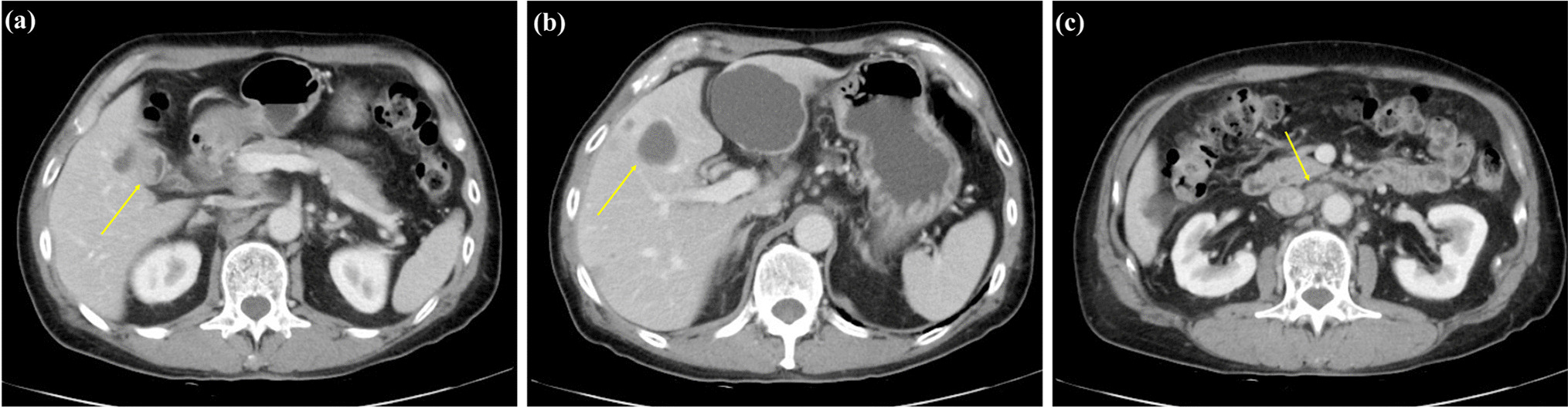 Exceptional Response to Pembrolizumab in HER2-Positive Gallbladder Carcinoma with High Tumor Mutational Burden