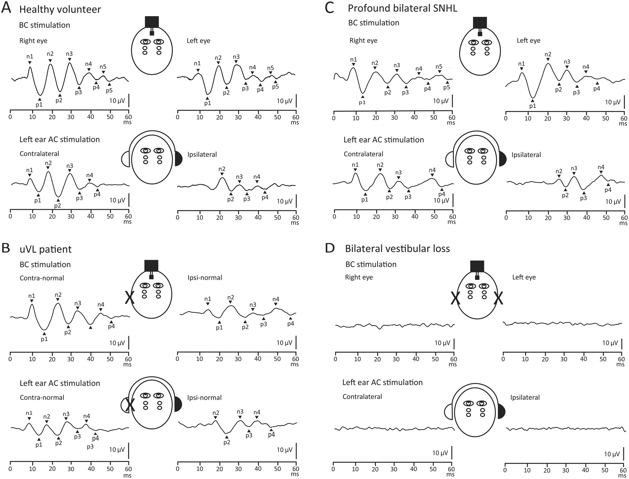 After the n10: late oVEMP peaks in patients with unilateral vestibular loss and healthy volunteers