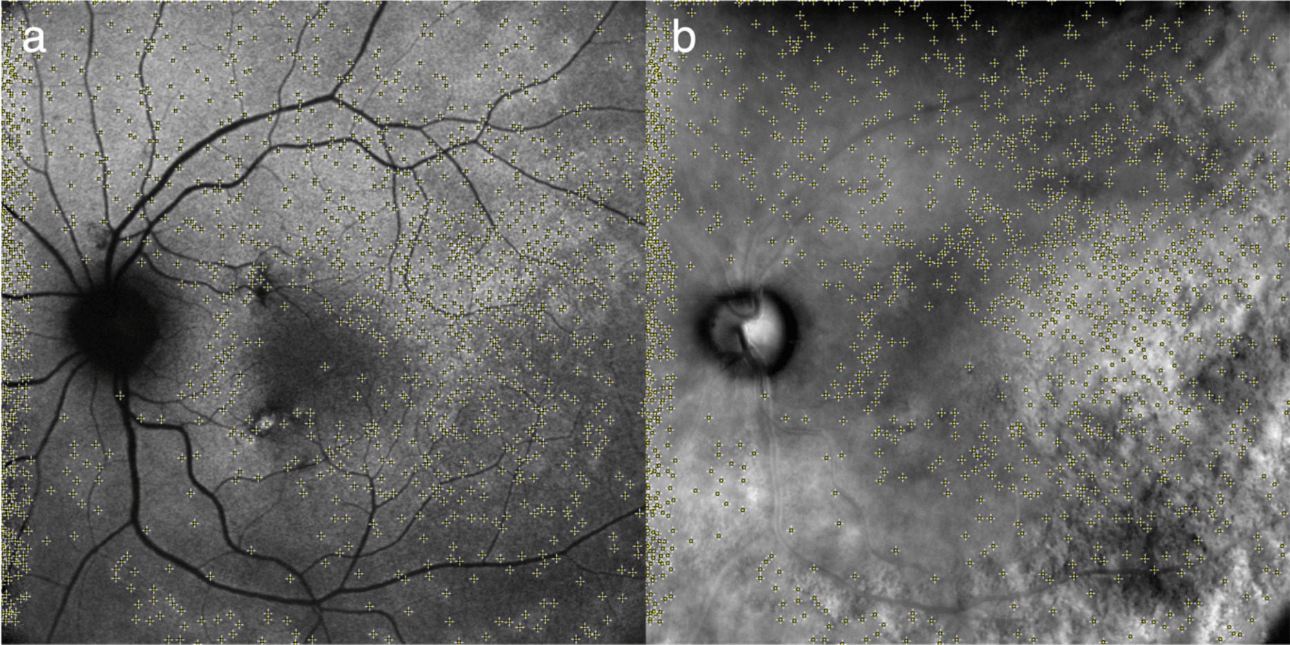 Retromode imaging in vitreoretinal lymphoma