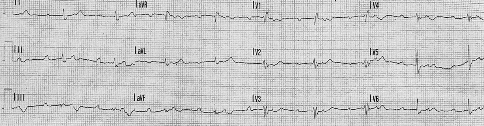 Permanent pacemaker implantation for atrioventricular block secondary to acute pancreatitis in a patient affected by panhypopituitarism