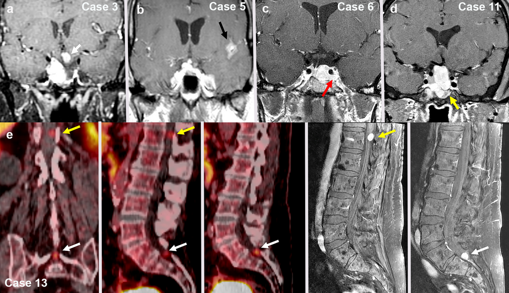 High-Grade Progression, Sarcomatous Transformation, and/or Metastasis of Pituitary Neuroendocrine Neoplasms (PitNENs): The UCSF Experience