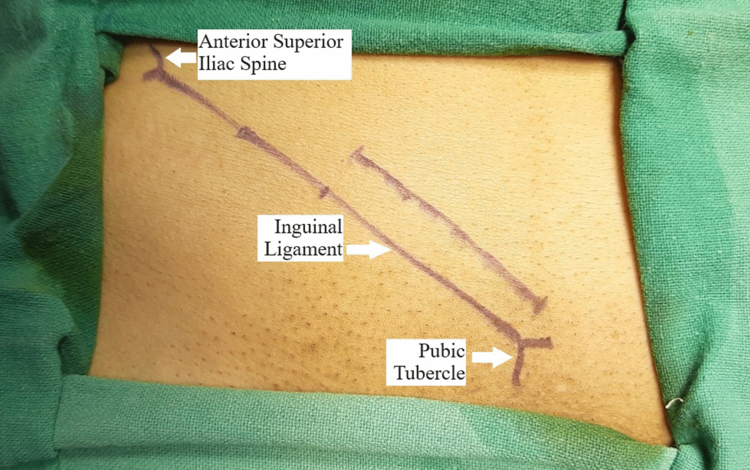 Oblique Incision Versus Transverse Incision in Open Inguinal Hernia Repair — A Comparative Study