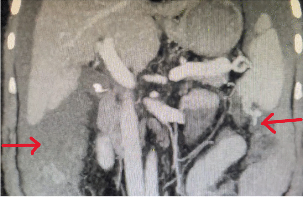An Extremely Rare Case of Spontaneous Hemoperitoneum Due to Rupture of Ectopic Varices in Cirrhosis of Liver