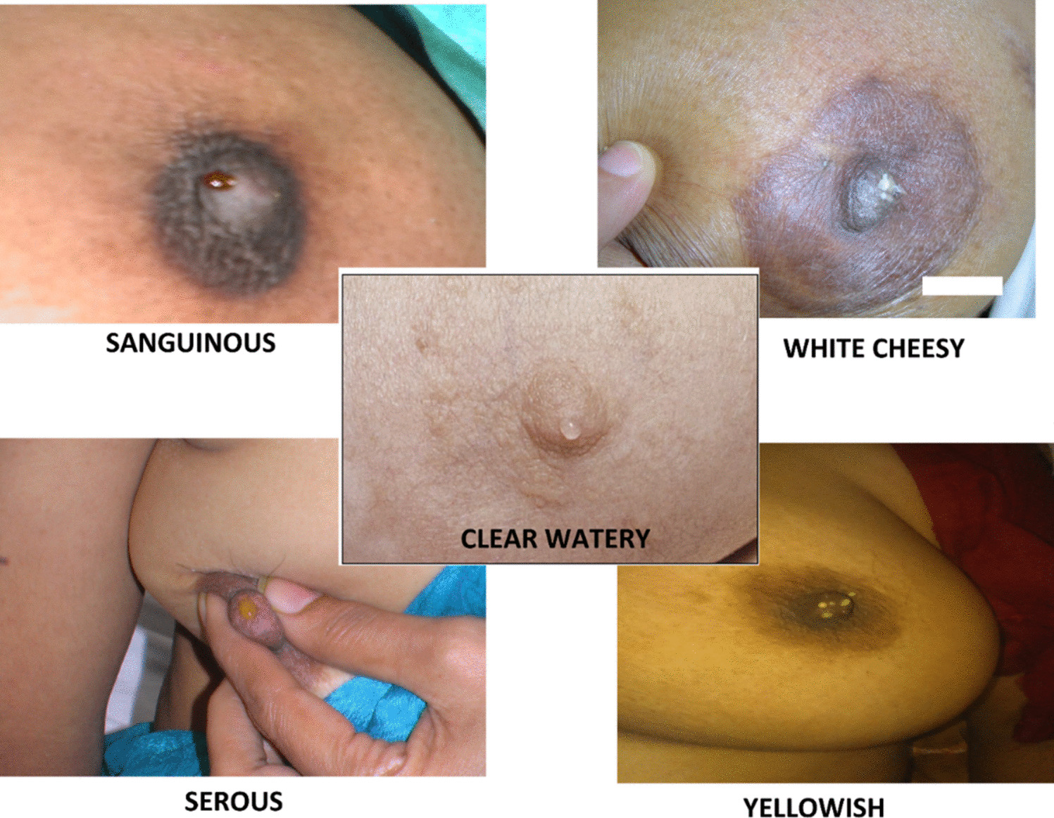 Asian Society of Mastology (ASOMA) Guide for Management of Nipple Discharge