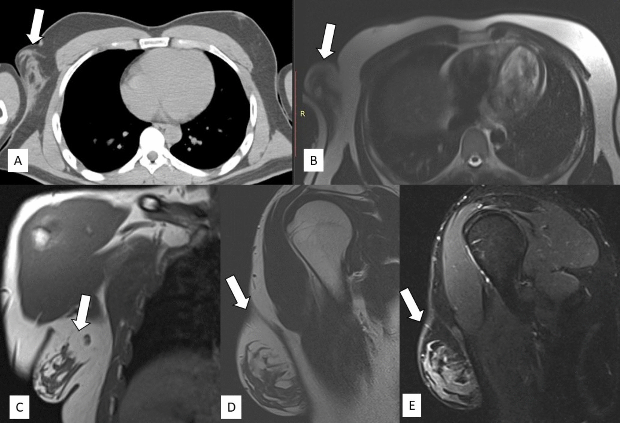Unilateral Enlarged Axillary Accessory Breast in Male