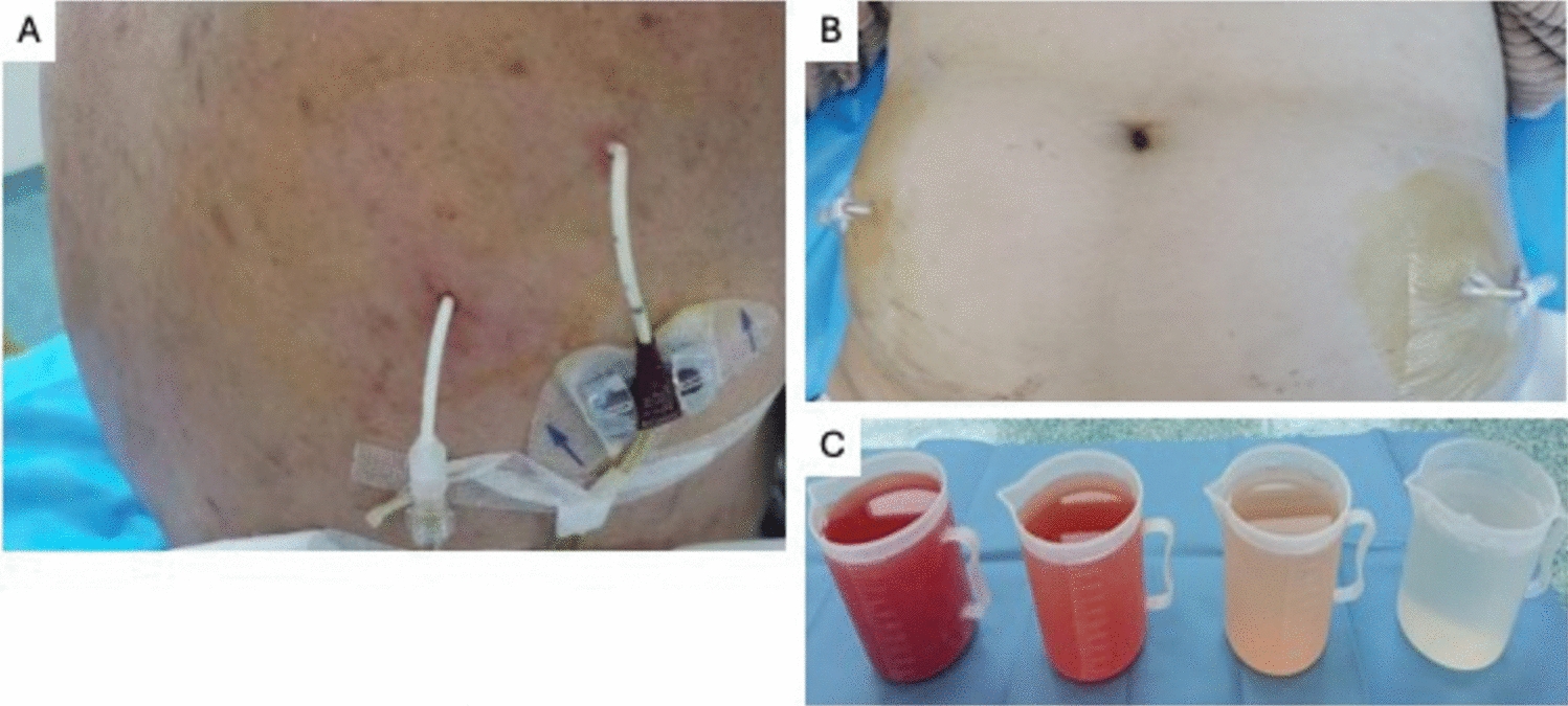 Pharmacokinetics of cisplatin in the systemic versus hyperthermic intrathoracic or intraperitoneal chemotherapy