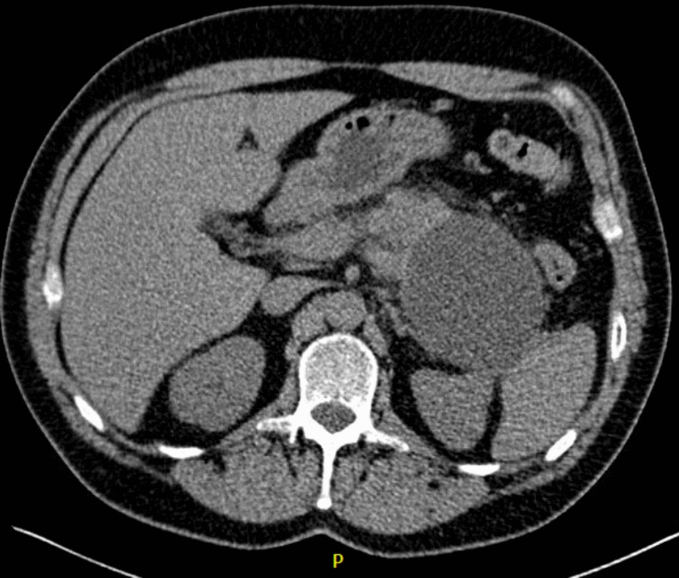 Diagnostic challenge: pancreatic cancer masked by peripancreatic fluid collection after acute pancreatitis