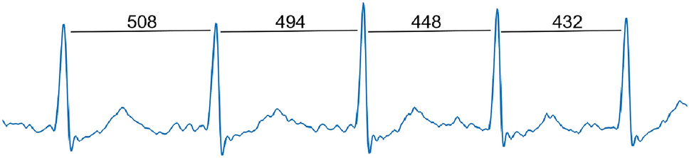 A review of automatic sleep stage classification using machine learning algorithms based on heart rate variability